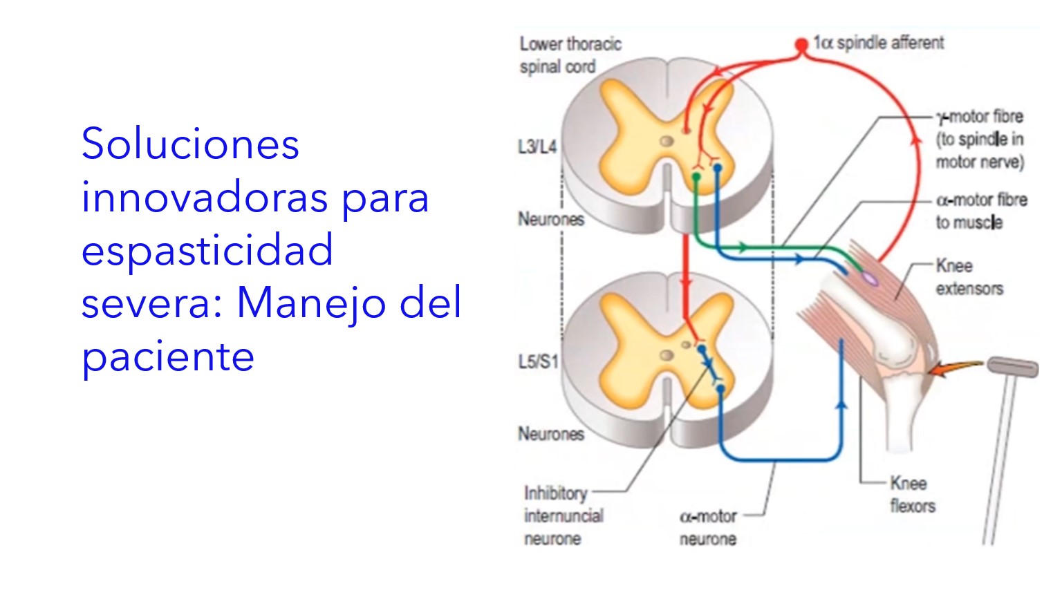 Soluciones Innovadoras para Espasticidad Severa: Manejo del Paciente.|Soluções inovadoras para espasticidade grave: gerenciamento de pacientes.|Innovative Solutions for Severe Spasticity: Patient Management.